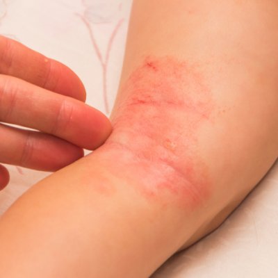 Istock image of crook of child's knee with eczema all over it